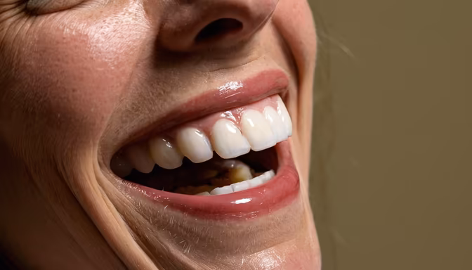 Smile Transformation