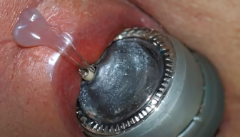 Dental Procedure Dental Procedure