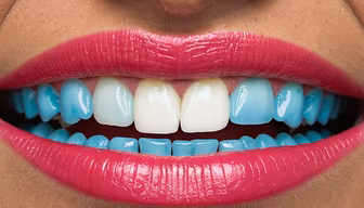 Smile Makeover Smile Makeover